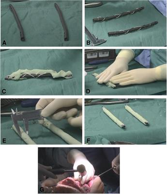 Treatment of Periprosthetic Joint Infection and Fracture-Related Infection With a Temporary Arthrodesis Made by PMMA-Coated Intramedullary Nails – Evaluation of Technique and Quality of Life in Implant-Free Interval